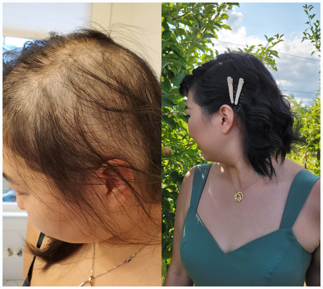 Alopecia Areata-Lg White-Stroke