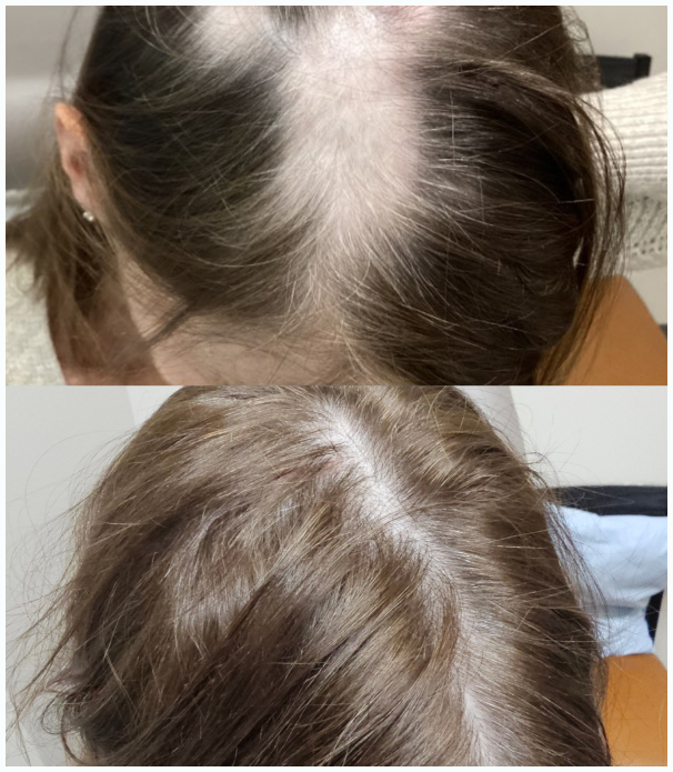 Female-HairLoss-Header1